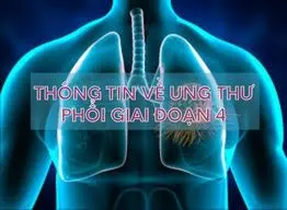 Ung thư phổi giai đoạn 4 và những thông tin hữu ích cần biết 